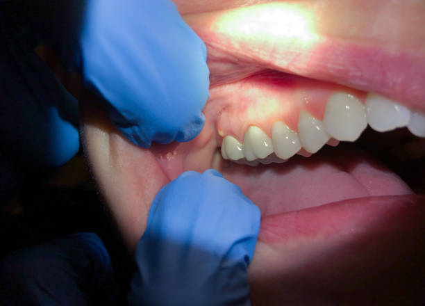 Best Emergency Dental Care for Broken or Chipped Teeth in Crownpoint, NM